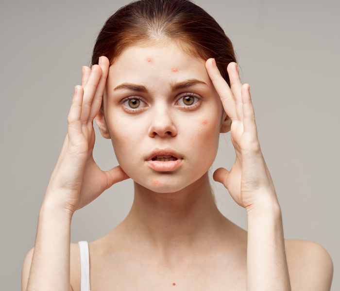 Why Do Pimples (Acne) Form?