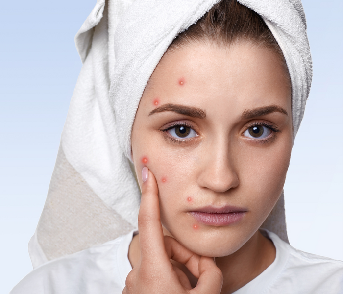 What Is Acne And How Do You Get Rid Of It?